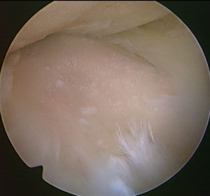 関節軟骨が完全に消失した骨の表面