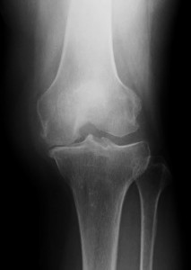 左ひざのレントゲン
