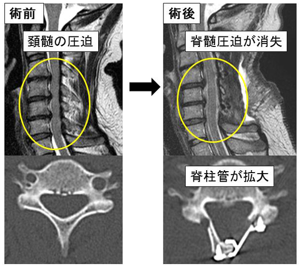 頚椎椎弓形成術