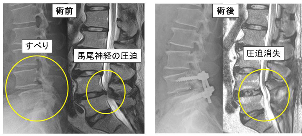 後方経路腰椎椎体間固定術 (PLIF)