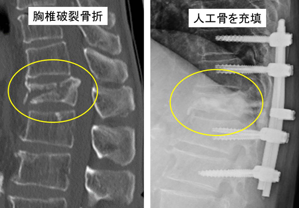 胸腰椎後方固定術+椎体形成術