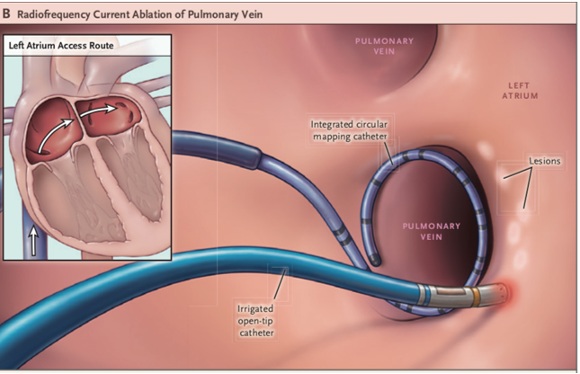 肺静脈隔離術後