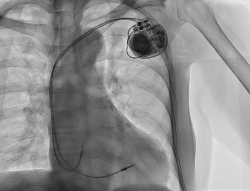 ペースメーカ植え込み後の画像