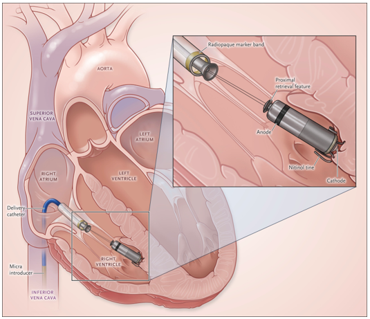 リードレスペースメーカ植え込みの概略図