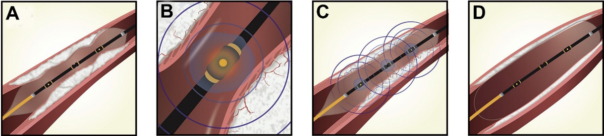 ショックウェーブ