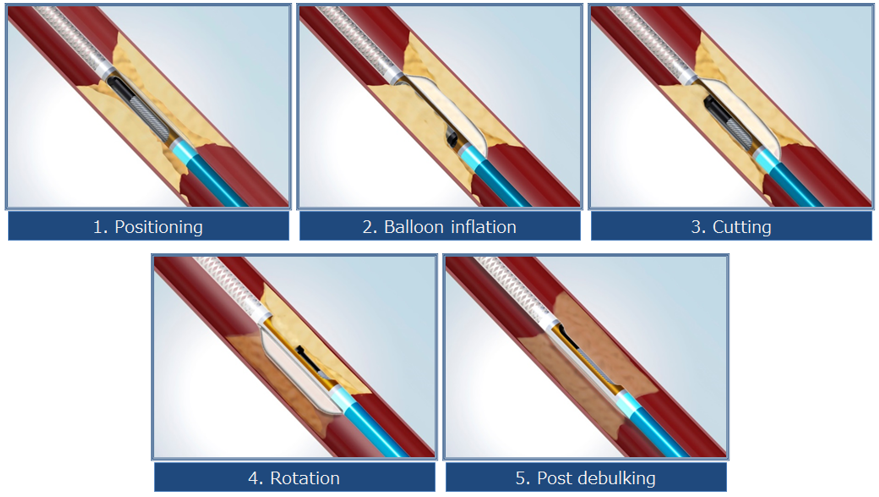DCA（方向性冠動脈粥腫切除術）