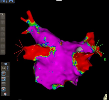 肺静脈隔離術前