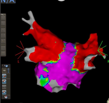 肺静脈隔離術後