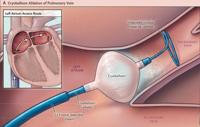 肺静脈隔離術前
