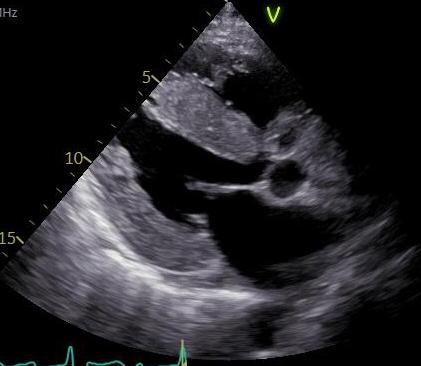 傍胸骨長軸断面