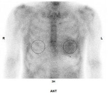 図４ 骨シンチ(99mピロリン酸)グラフィー